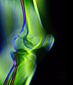 Coloured X-ray of a human knee joint