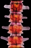 Coloured X-ray of lumbar vertebrae of the