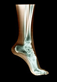 Coloured X-ray of the bones in the foot