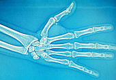 Adult hand X-ray
