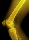 Knee joint,X-ray