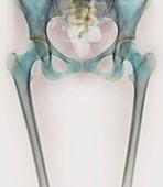 Hip bones,X-ray