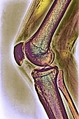 Knee joint,X-ray