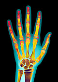 Child's hand,X-ray