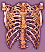Rib cage,3D CT scan