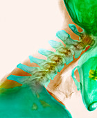 Neck vertebrae extended,X-ray