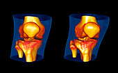 Knees,CT scan