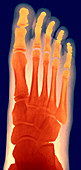 Child's foot,X-ray