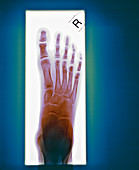 Foot,X-ray