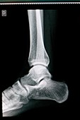 Ankle joint,X-ray