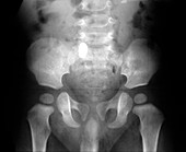 Child's pelvis,X-ray