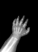Baby's hand,X-ray