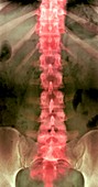 Normal lumbar spine,X-ray