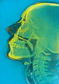 Human skull,X-ray