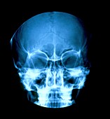 X-ray of 16-year-old girl's skull showing sinuses