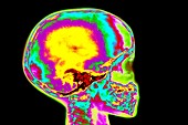 Coloured X-ray of child's skull and tooth eruption