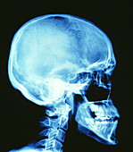 Skull X-ray