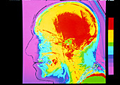 Human skull,CT scan