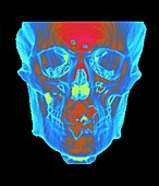 Skull,CT scan