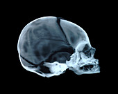 Baby's skull