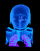 Child's head and chest,CT scan
