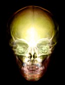 Young child's skull,X-ray