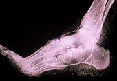 Normal arteriogram of foot