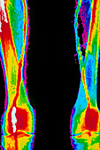Coloured angiogram of arteries in the legs