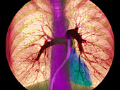 Coloured angiogram showing the pulmonary arteries