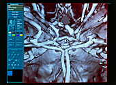 3-D CT scan of the circle of Willis blood vessels