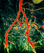 Groin arteries,MRA