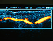 Finger blood flow,ultrasound scan
