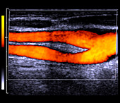 Carotid artery,doppler ultrasound