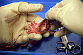 Dissected aorta and aortic valve
