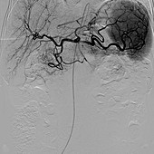 Abdominal arteries,X-ray