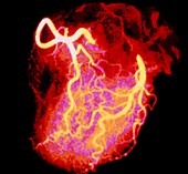F/col normal coronary angiogram