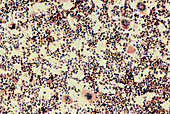 Developing blood cells seen in the bone marrow