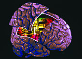 Colour 3-D MRI brain scan with circuit board in it