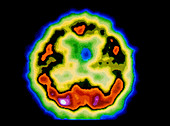 PET scan of an axial section through a human brain