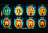 PET scans showing protein synthesis in the brain