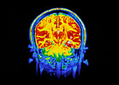 False-colour frontal MRI scan of a child's head