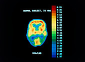 PET Scan of brain of normal subject