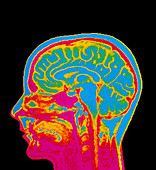 MRI scan of normal brain