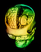 F/colour 3-D CT scan of human brain within skull