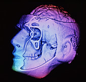 Human brain in head CT scan