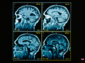 Four MRI scans through the brain,side view