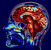 Coloured MRI scan of brain in sagittal se