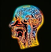 Coloured MRI scan of the human head (side view)