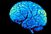 Coloured 3-D MRI scan of brain seen from the side