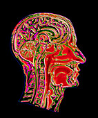 Coloured CT scan of a head showing a healthy brain